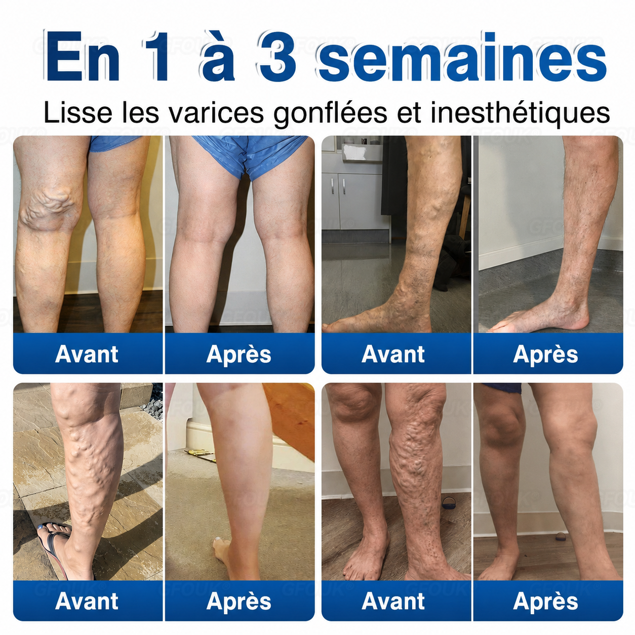 🌴🌴GFOUK® Réparation Veineuse Baume Aux Micro-Aiguilles