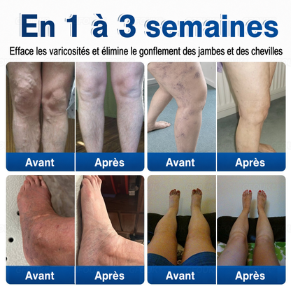 🌴🌴GFOUK® Réparation Veineuse Baume Aux Micro-Aiguilles