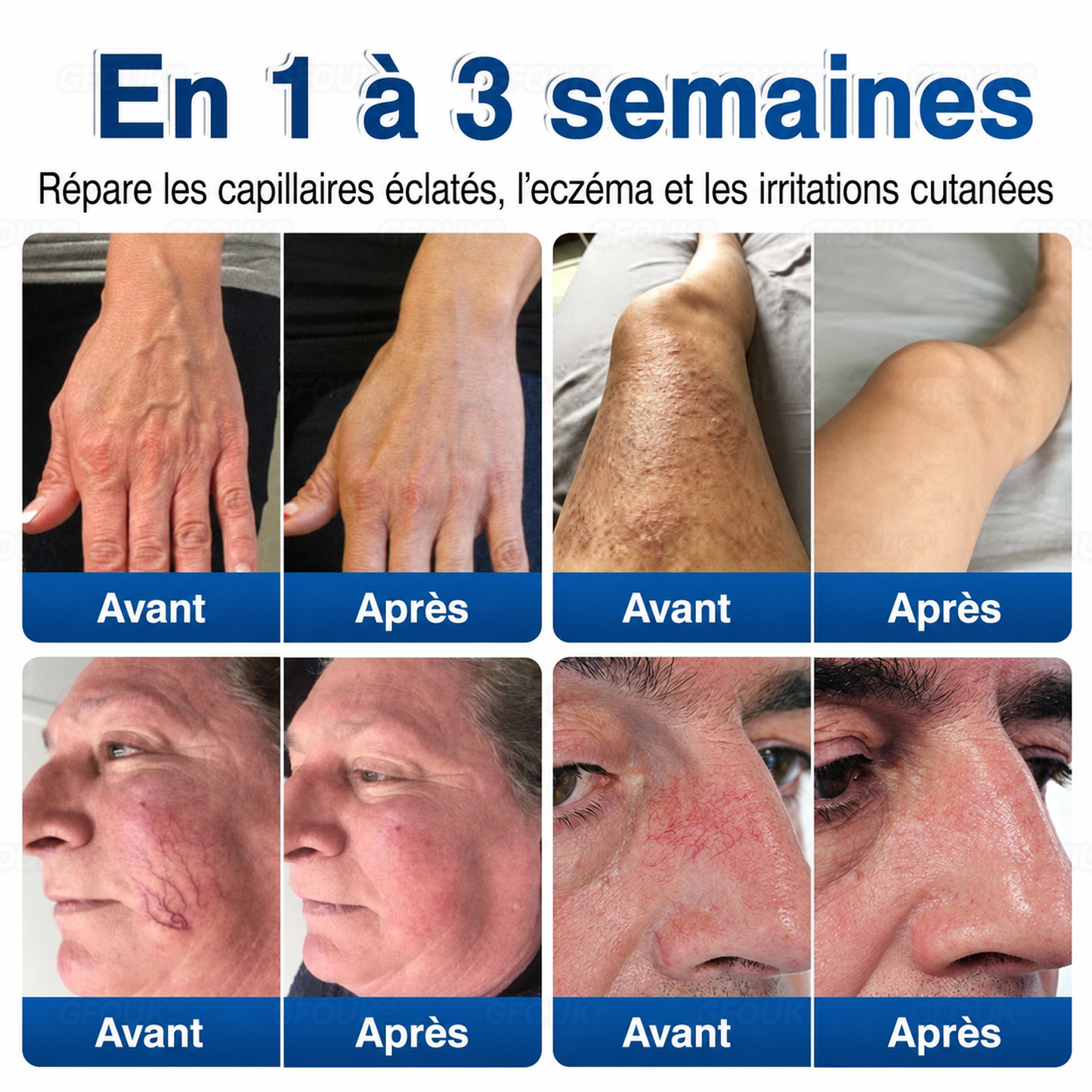 🌴🌴GFOUK® Réparation Veineuse Baume Aux Micro-Aiguilles