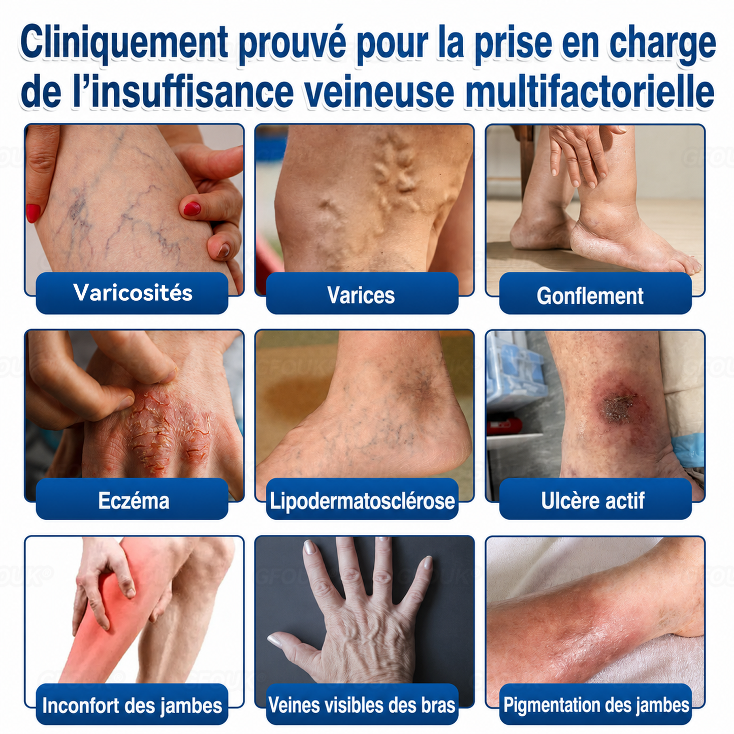 🌴🌴GFOUK® Réparation Veineuse Baume Aux Micro-Aiguilles