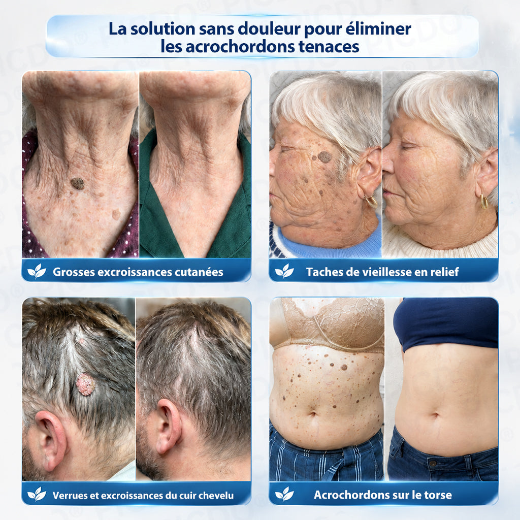 🔥🔥🔥𝐏𝐢𝐜𝐝𝐨® 𝐂𝐫è𝐦𝐞 𝐄𝐟𝐟𝐚𝐜𝐞𝐮𝐫 𝐝’𝐀𝐜𝐫𝐨𝐜𝐡𝐨𝐫𝐝𝐨𝐧𝐬 & 𝐝𝐞 𝐓𝐚𝐜𝐡𝐞𝐬 – 𝟕 𝐉𝐨𝐮𝐫𝐬(𝐅𝐨𝐫𝐦𝐮𝐥𝐞 𝐙é𝐫𝐨 𝐃𝐨𝐮𝐥𝐞𝐮𝐫, 𝐙é𝐫𝐨 𝐂𝐢𝐜𝐚𝐭𝐫𝐢𝐜𝐞)💥