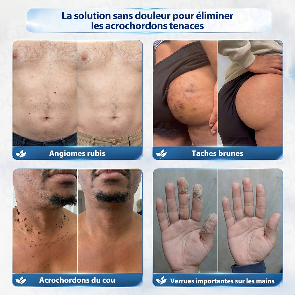 🔥🔥🔥𝐏𝐢𝐜𝐝𝐨® 𝐂𝐫è𝐦𝐞 𝐄𝐟𝐟𝐚𝐜𝐞𝐮𝐫 𝐝’𝐀𝐜𝐫𝐨𝐜𝐡𝐨𝐫𝐝𝐨𝐧𝐬 & 𝐝𝐞 𝐓𝐚𝐜𝐡𝐞𝐬 – 𝟕 𝐉𝐨𝐮𝐫𝐬(𝐅𝐨𝐫𝐦𝐮𝐥𝐞 𝐙é𝐫𝐨 𝐃𝐨𝐮𝐥𝐞𝐮𝐫, 𝐙é𝐫𝐨 𝐂𝐢𝐜𝐚𝐭𝐫𝐢𝐜𝐞)💥