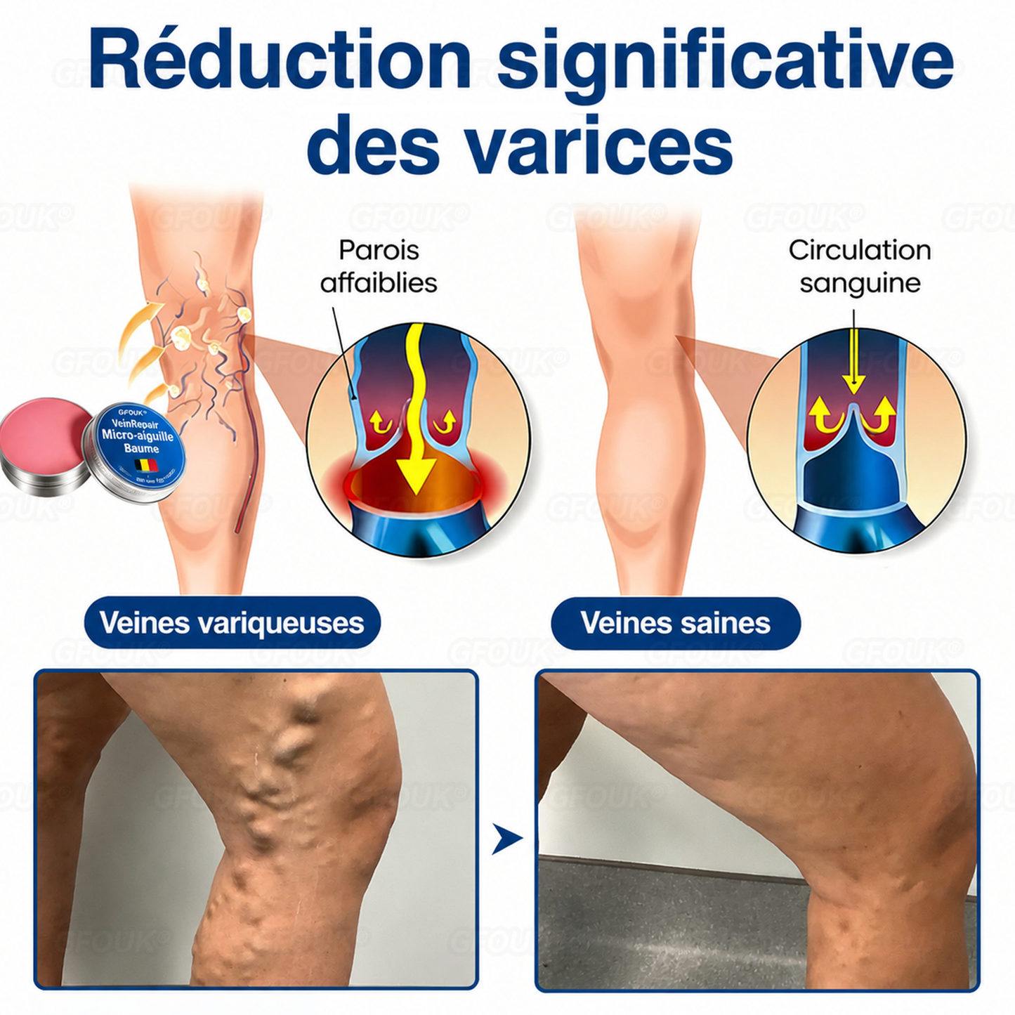 🌴🌴GFOUK® Réparation Veineuse Baume Aux Micro-Aiguilles