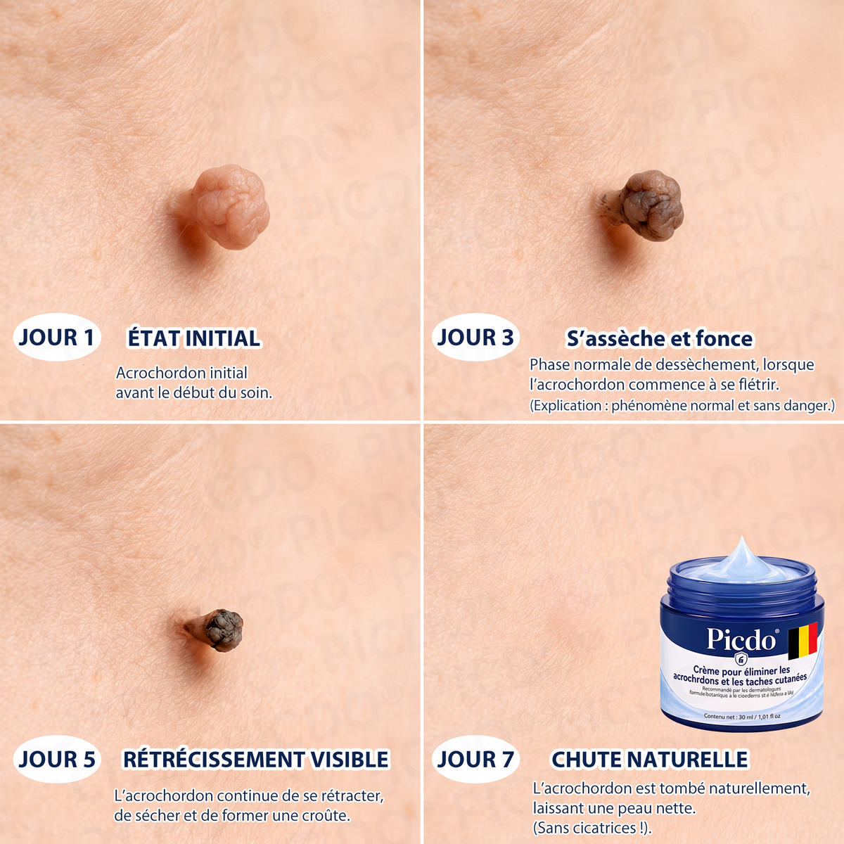 🔥🔥🔥𝐏𝐢𝐜𝐝𝐨® 𝐂𝐫è𝐦𝐞 𝐄𝐟𝐟𝐚𝐜𝐞𝐮𝐫 𝐝’𝐀𝐜𝐫𝐨𝐜𝐡𝐨𝐫𝐝𝐨𝐧𝐬 & 𝐝𝐞 𝐓𝐚𝐜𝐡𝐞𝐬 – 𝟕 𝐉𝐨𝐮𝐫𝐬(𝐅𝐨𝐫𝐦𝐮𝐥𝐞 𝐙é𝐫𝐨 𝐃𝐨𝐮𝐥𝐞𝐮𝐫, 𝐙é𝐫𝐨 𝐂𝐢𝐜𝐚𝐭𝐫𝐢𝐜𝐞)💥